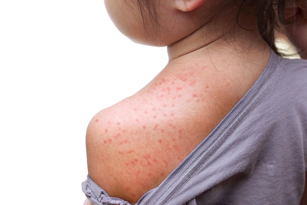 Measles epidemic takes over in Venezuela; Curaçao must be watchful